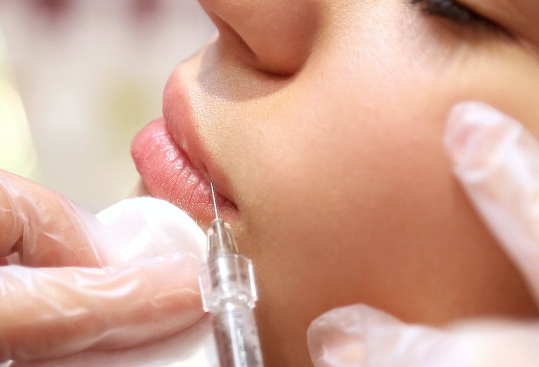 Powiększanie ust kwasem hialuronowym – jakie ma zalety to rozwiązanie?